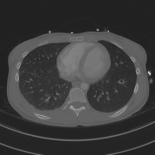 Abdominal multi-trauma - devascularised kidney and liver, spleen and pancreatic lacerations (Radiopaedia 34984-36486 I 59).png