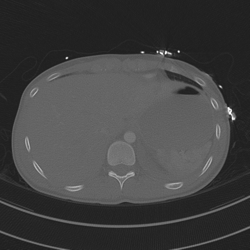 File:Abdominal multi-trauma - devascularised kidney and liver, spleen and pancreatic lacerations (Radiopaedia 34984-36486 I 76).png