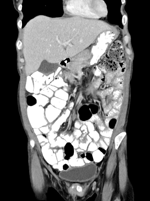 Abdominal wall and retroperitoneal tuberculosis (Radiopaedia 88137-104729 Coronal C+ portal venous phase 29).jpg