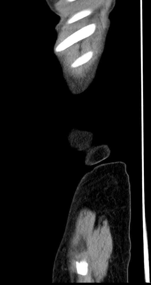 Abdominal wall and retroperitoneal tuberculosis (Radiopaedia 88137-104729 Sagittal C+ portal venous phase 144).jpg