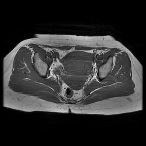 File:Abdominal wall endometriosis (Radiopaedia 83702-98847 Axial T1 10).jpg