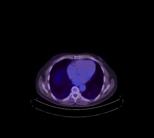 Abdominal wall metastasis from colorectal carcinoma (Radiopaedia 31016-31719 Axial 100).jpg