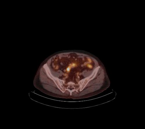 Abdominal wall metastasis from colorectal carcinoma (Radiopaedia 31016-31719 C 39).jpg