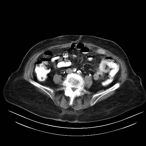File:Abdominal wall recurrence after colorectal resection for cancer (Radiopaedia 23444-23523 Axial C+ portal venous phase 21).jpg