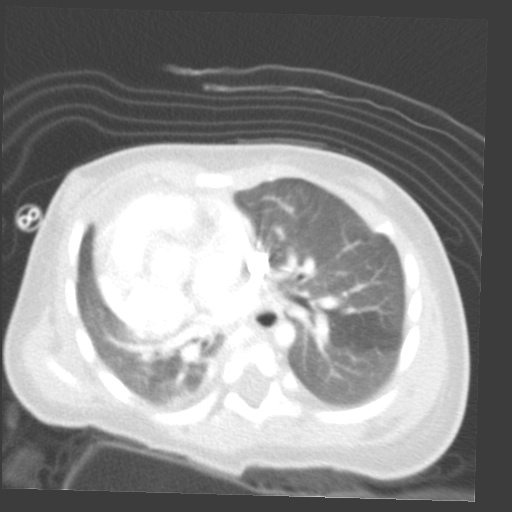 File:Aberrant left pulmonary artery (pulmonary sling) (Radiopaedia 42323-45435 Axial lung window 20).jpg