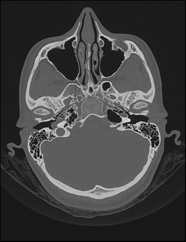 Aberrant right internal carotid artery (Radiopaedia 65191-74198 Axial non-contrast 36).jpg