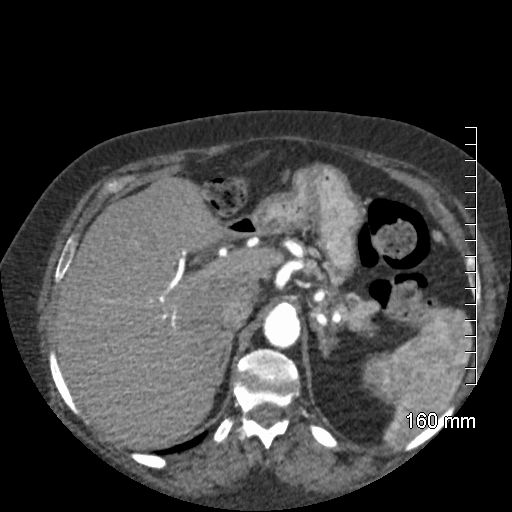 File:Aberrant right subclavian artery stenosis (Radiopaedia 52656-58670 Axial C+ arterial phase 85).jpg
