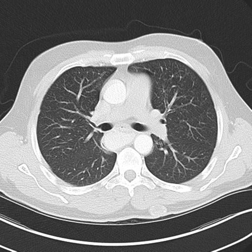 Achalasia of the cardia (Radiopaedia 38497-40595 Axial lung window 23).png