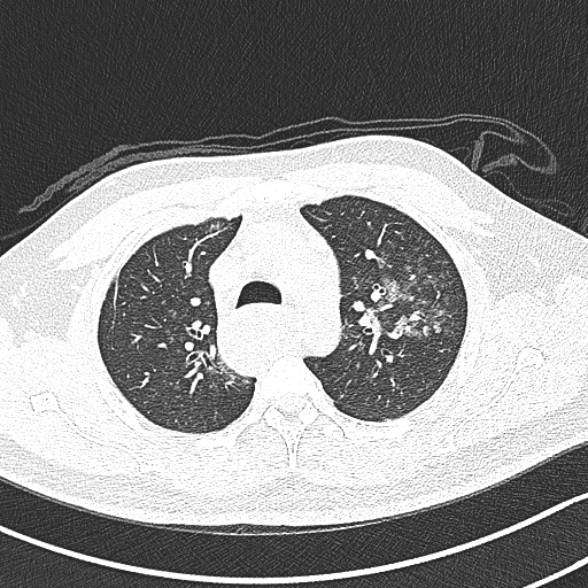 File:Achalasia with aspiration (Radiopaedia 55413-61845 Axial lung window 20).jpg
