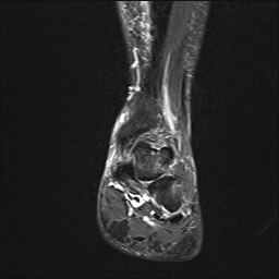 File:Achilles tendon tear (Radiopaedia 77615-89819 Coronal STIR 13).jpg