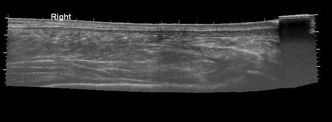File:Achilles tendon tear (Radiopaedia 9759-10362 Longitudinal 1).jpg