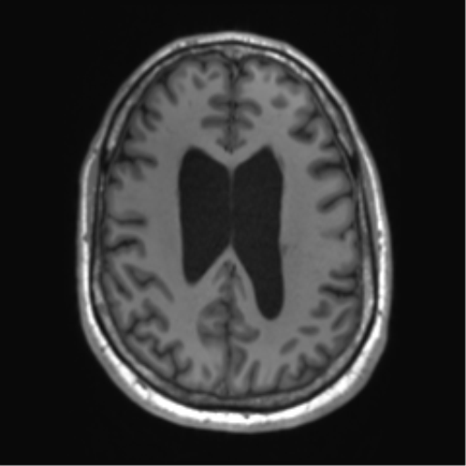 File:Achondroplasia (Radiopaedia 65109-74105 Axial T1 18).png