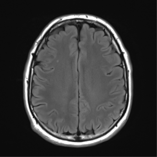 File:Acoustic schwannoma (Radiopaedia 50846-56358 Axial FLAIR 22).png