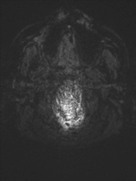 Acoustic schwannoma (Radiopaedia 55729-62281 Axial SWI 55).png