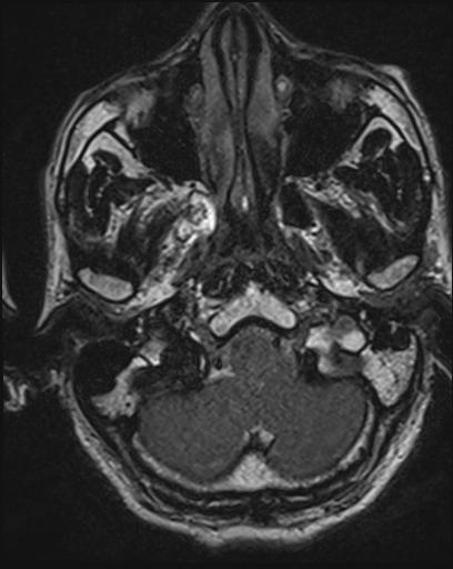 Acoustic schwannoma - probable (Radiopaedia 20386-20292 Axial T1 21).jpg