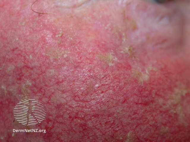 Actinic Keratoses affecting the face (DermNet NZ lesions-ak-face-413).jpg