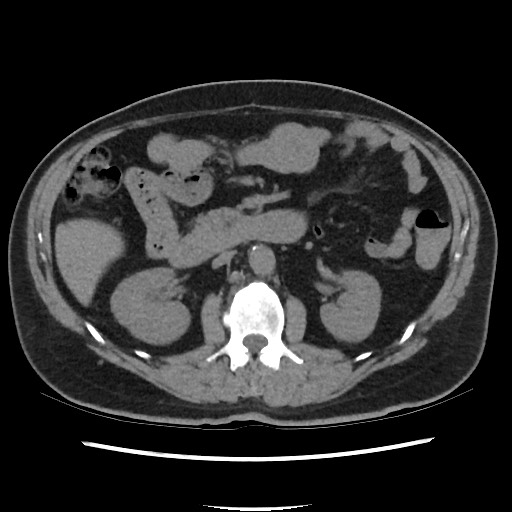 Active colonic bleed on CT (Radiopaedia 49765-55025 Axial non-contrast 33).jpg