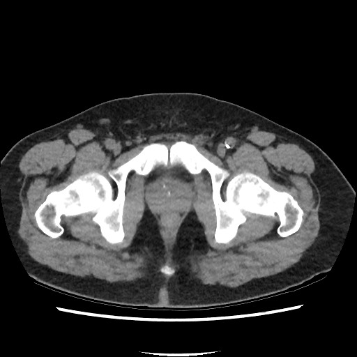 File:Active colonic bleed on CT (Radiopaedia 49765-55025 Axial non-contrast 83).jpg