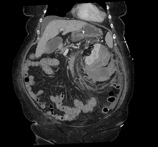 File:Active renal extravasation with large subcapsular and retroperitoneal hemorrhage (Radiopaedia 60975-68796 Coronal C+ portal venous phase 57).jpg