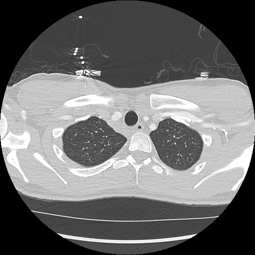 File:Active right ventricular cardiac sarcoidosis (Radiopaedia 55596-62101 Axial lung window 1).jpg