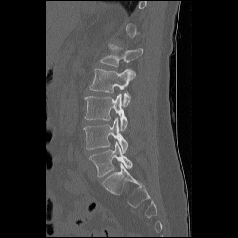 Acute Schmorl's node (Radiopaedia 83276-102365 Sagittal bone window 31).jpg