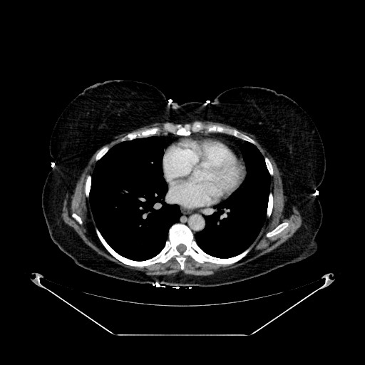Acute appendicitis, heterotaxy syndrome (Radiopaedia 66884-76202 Axial C+ portal venous phase 2).jpg