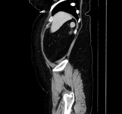Acute appendicitis, heterotaxy syndrome (Radiopaedia 66884-76202 Sagittal C+ portal venous phase 28).jpg