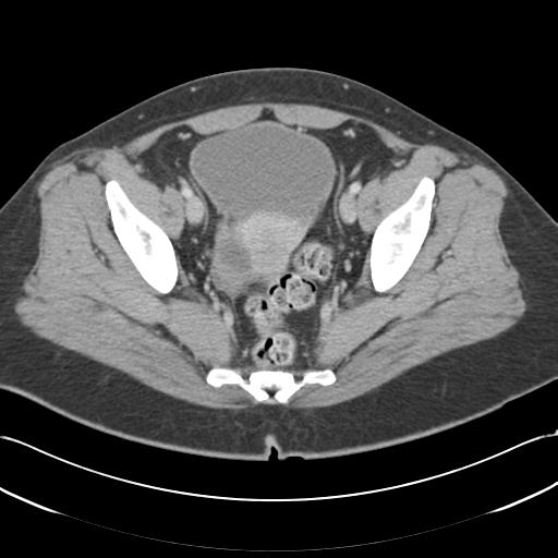 Acute appendicitis (Radiopaedia 30297-30934 Axial C+ portal venous phase 70).jpg