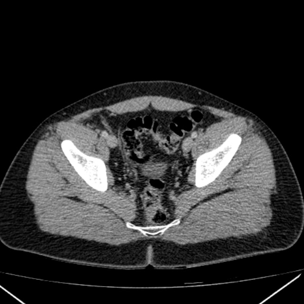 Acute appendicitis (Radiopaedia 38255-40270 Axial C+ portal venous phase 96).jpg