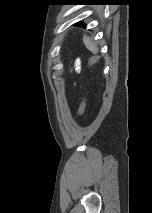 Acute appendicitis (Radiopaedia 48511-53463 Sagittal C+ portal venous phase 117).jpg