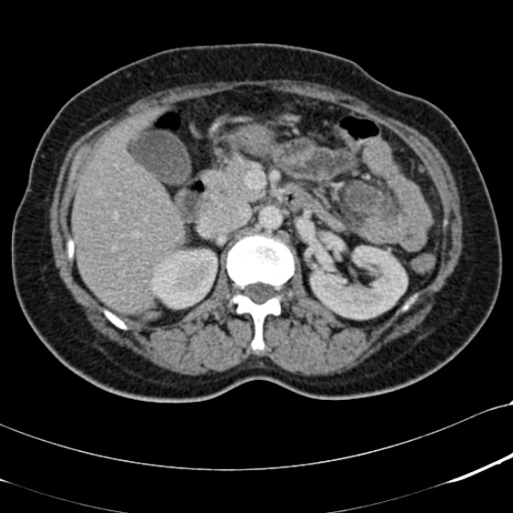 Acute appendicitis (Radiopaedia 48792-53822 Axial C+ portal venous phase 41).jpg