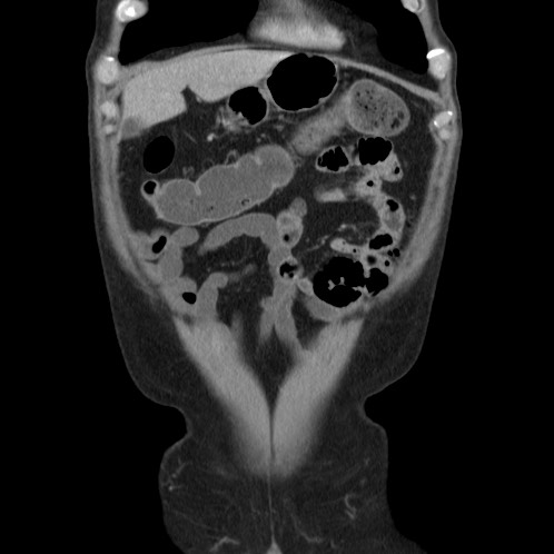 Acute appendicitis (Radiopaedia 66513-75790 Coronal C+ portal venous phase 4).jpg