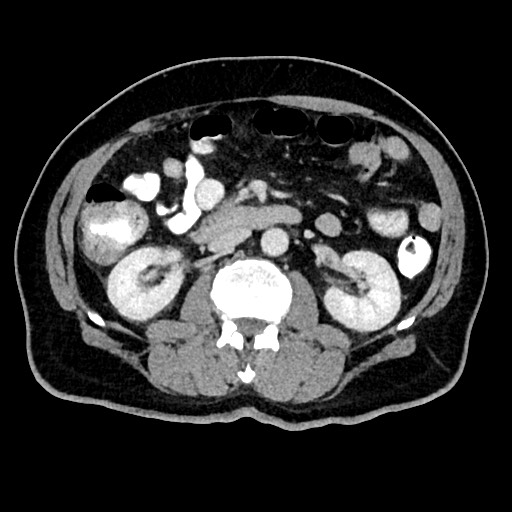 Acute appendicitis (Radiopaedia 77016-88960 Axial C+ portal venous phase 65).jpg