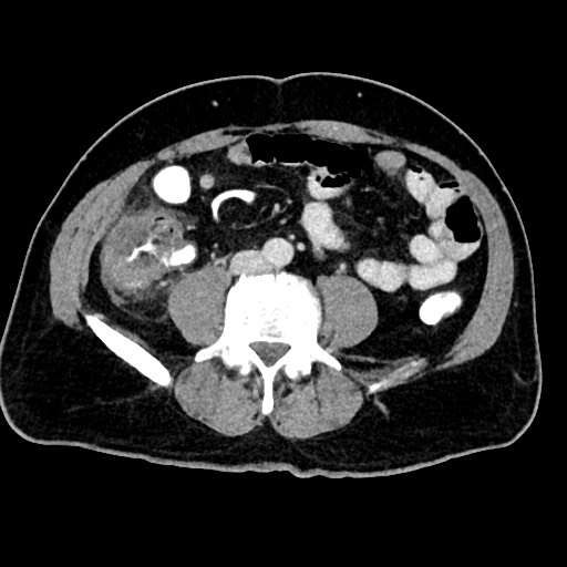 Acute appendicitis (Radiopaedia 77016-88960 Axial C+ portal venous phase 89).jpg