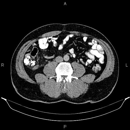 File:Acute appendicitis (Radiopaedia 84780-100240 Axial C+ portal venous phase 62).jpg
