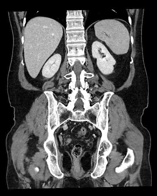 Acute appendicitis - large appendicoliths (Radiopaedia 61805-69820 Coronal C+ portal venous phase 96).jpg
