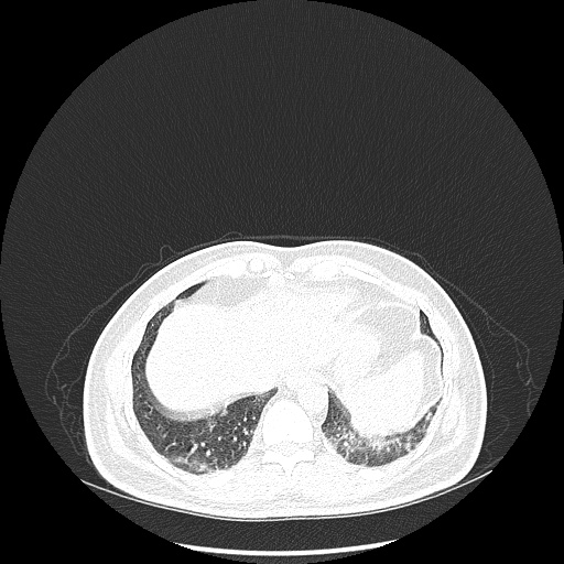 Acute appendicitis and COVID 19 pneumonia (Radiopaedia 76604-88380 Axial lung window 46).jpg