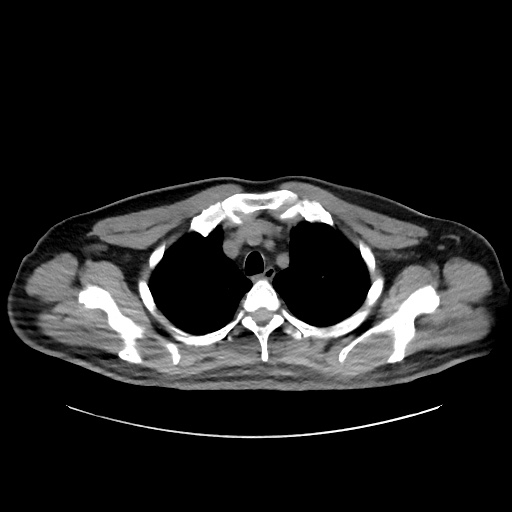 Acute appendicitis and COVID 19 pneumonia (Radiopaedia 76604-88380 Axial non-contrast 13).jpg