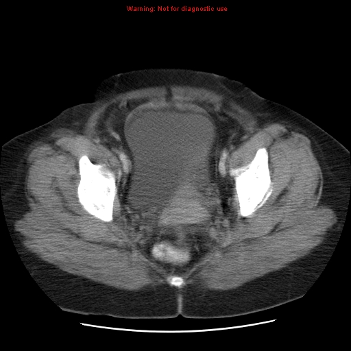 Acute appendicitis complicated by ovarian vein thrombophlebitis (Radiopaedia 16172-15851 Axial C+ portal venous phase 79).jpg