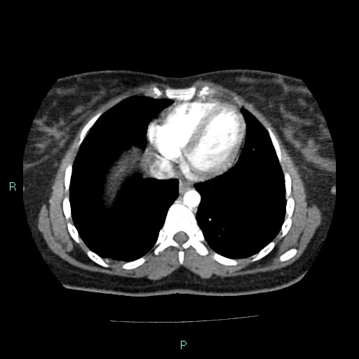 Acute bilateral pyelonephritis (Radiopaedia 37146-38881 Axial C+ arterial phase 1).jpg