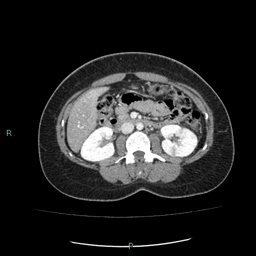 Acute bilateral pyelonephritis (Radiopaedia 37146-38881 Axial C+ portal venous phase 47).jpg