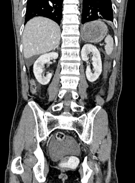 Acute bowel ischemia (Radiopaedia 87695-104114 Coronal C+ portal venous phase 271).jpg