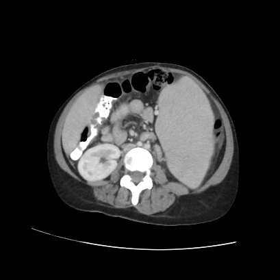 File:Acute calculous cholecystitis in patient with osteopetrosis (Radiopaedia 77871-90159 Axial C+ portal venous phase 48).jpg