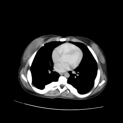 File:Acute calculous cholecystitis in patient with osteopetrosis (Radiopaedia 77871-90159 Axial C+ portal venous phase 7).jpg
