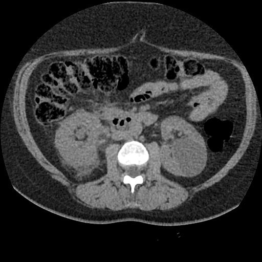 File:Acute cholecystitis and ureteric colic (Radiopaedia 42330-45444 Axial prone 45).jpg