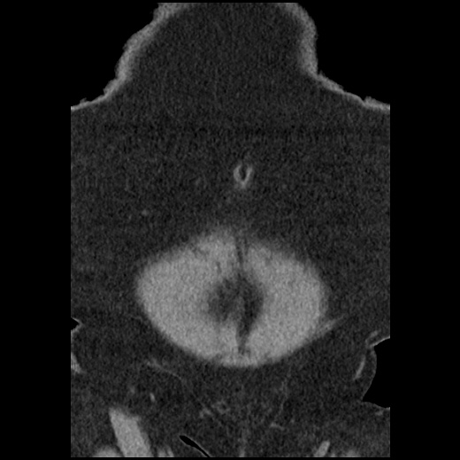 Acute cholecystitis and ureteric colic (Radiopaedia 42330-45444 Coronal prone 17).jpg
