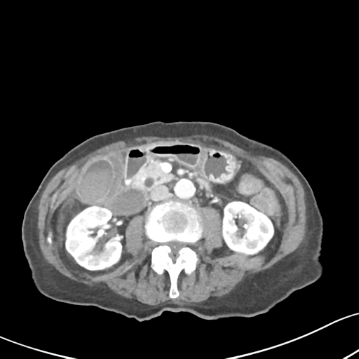 Acute cholecystitis with contained perforation (Radiopaedia 47328-51907 Axial C+ portal venous phase 33).png