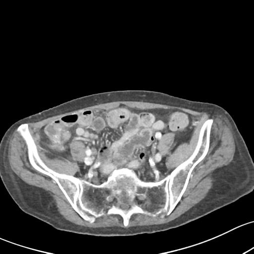 File:Acute cholecystitis with contained perforation (Radiopaedia 47328-51907 Axial C+ portal venous phase 54).png