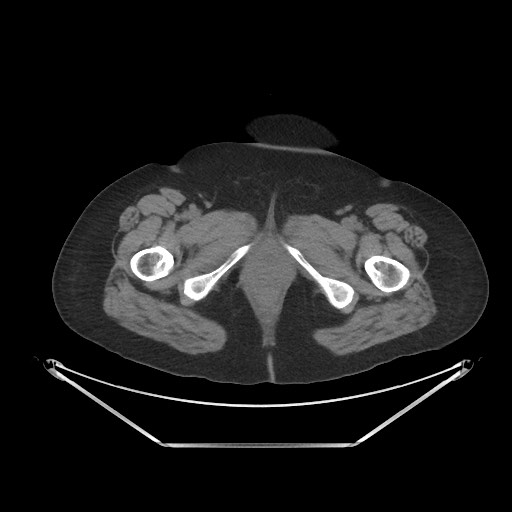 File:Acute cholecystitis with tensile fundus sign (Radiopaedia 71394-81723 Axial non-contrast 127).jpg
