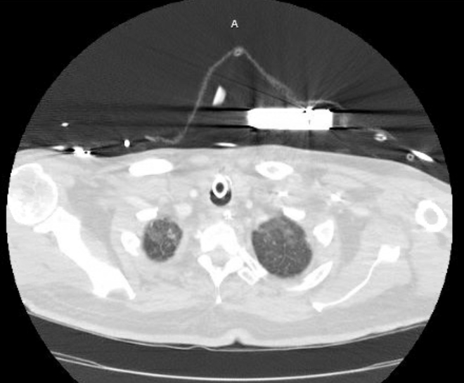 Acute cor pulmonale (ultrasound) (Radiopaedia 83508-98818 Axial lung window 6).jpg